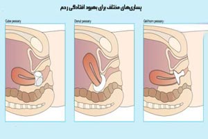 نشانه های افتادگی رحم در زنان + عکس نشانه های افتادگی رحم در زنان + عکس
