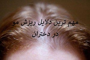 علت ریزش مو در دختران + درمان علت ریزش مو در دختران + درمان