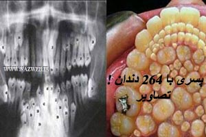 پسر عجیبی با 264 دندان جهان را شوکه کرد + تصاویر