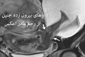 پاهای بیرون زده جنین از رحم مادر جنجالی شد ! عکس پاهای بیرون زده جنین از رحم مادر جنجالی شد ! عکس