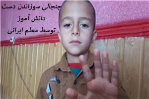 معلم بی رحم ایرانی دست دانش آموزش را سوزاند (عکس) معلم بی رحم ایرانی دست دانش آموزش را سوزاند (عکس)
