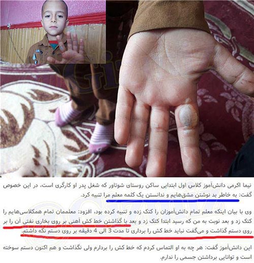 معلم بی رحم ایرانی دست دانش آموزش را سوزاند (عکس)