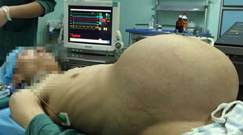 جراحی تومور عجیب ترین مرد حامله دنیا (عکس 16+)