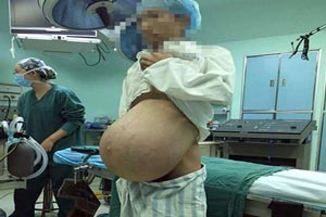 جراحی تومور عجیب ترین مرد حامله دنیا (عکس 16+) جراحی تومور عجیب ترین مرد حامله دنیا (عکس 16+)