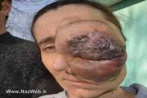 توموری که نصف صورت این زن را بلعید (عکس) توموری که نصف صورت این زن را بلعید (عکس)