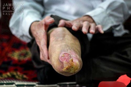 گزارش تکان دهنده شهرک جذامی ها در مشهد (18+ تصاویر)