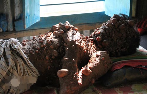 مردی که هزاران بیضه مردانه روی بدنش حمل می کند (تصاویر 18+)