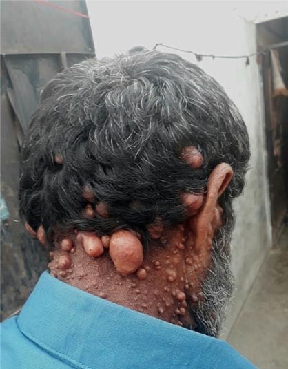 مردی که هزاران بیضه مردانه روی بدنش حمل می کند (تصاویر 18+)