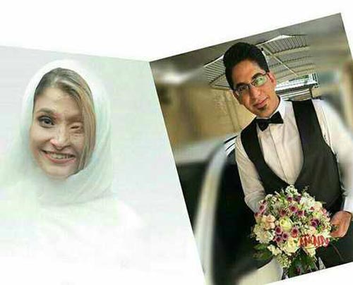 ازدواج دختر قربانی اسیدپاشی اصفهان با نصف صورت + تصاویر