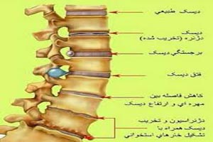 تست تصویری تشخیص دیسک کمر تست تصویری تشخیص دیسک کمر