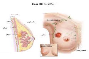داروی جدید برای سرطان سینه متاستاتیک داروی جدید برای سرطان سینه متاستاتیک