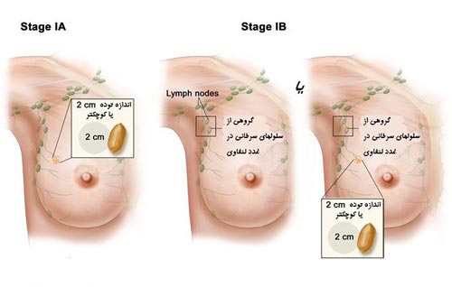 داروی جدید برای سرطان سینه متاستاتیک