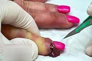 عوارض کاشت ناخن + تصاویر وحشتناک