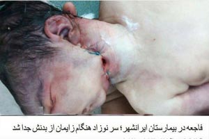 کنده شدن سر نوازد هنگام زایمان در ایرانشهر جنجالی شد + تصاویر