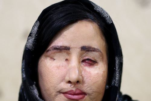 عکس های دردناک جنجالی ترین دختر اصفهانی پس از چندین بار جراحی زیبایی