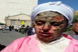 اسیدپاشی به دختر زیبای تبریزی با تصاویر و مصاحبه 18+