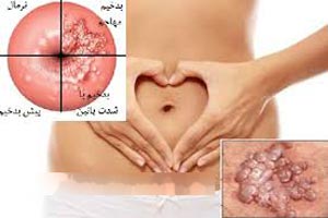 ویروس اچ پی وی قاتل هزاران زن در جهان ؟ علائم ویروس HPV