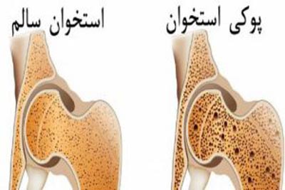 نشانه های پوکی استخوان در کودکان و نوزادان
