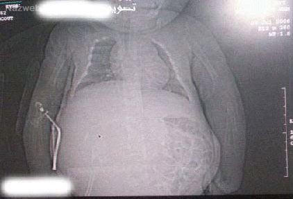 حاملگی 9 ماهه دختر یکساله سرراهی داغ ترین خبر دنیا + تصاویر