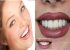 لمینت دندان چیست؛ تفاوت لمینت سرامیکی و کامپوزیتی