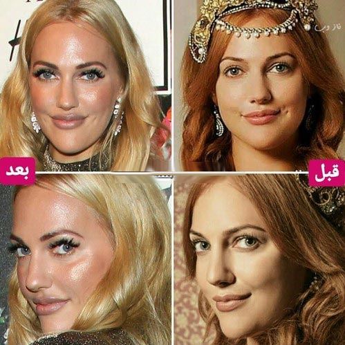 چهره شوکه کننده مریم اوزرلی بعد از بوتاکس! عکس