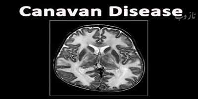 بیماری کارناوان چیست و چه علائمی دارد + عکس