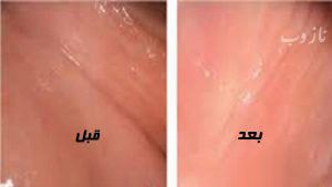 روش های جوان سازی و زیبایی واژن خانم ها 18+