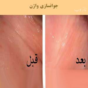 روش های جوان سازی و زیبایی واژن خانم ها 18+