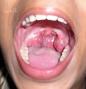 نشانه های سرطان گلو/ مهمترین علائم