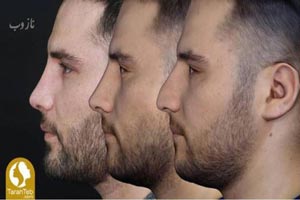 جدیدترین روش عمل بینی