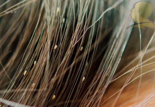 شپش چیست/ درمانهای دارویی و خانگی شپش +علائم آن