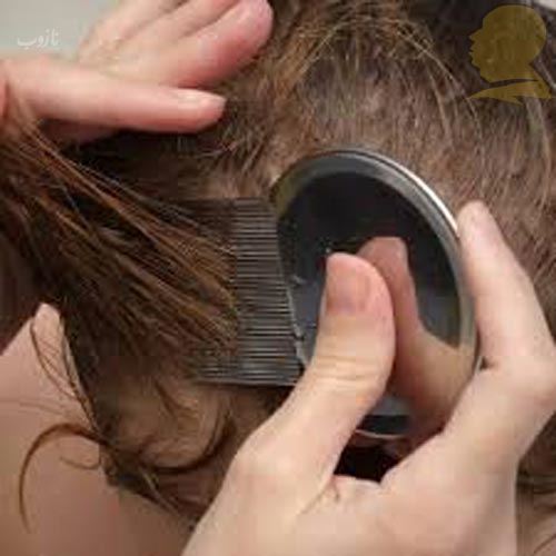 شپش چیست/ درمانهای دارویی و خانگی شپش +علائم آن