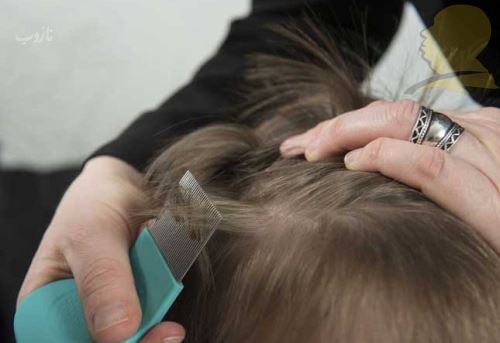 شپش چیست/ درمانهای دارویی و خانگی شپش +علائم آن