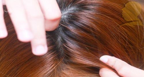 شپش چیست/ درمانهای دارویی و خانگی شپش +علائم آن