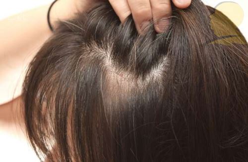 شپش چیست/ درمانهای دارویی و خانگی شپش +علائم آن