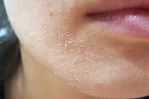 نشانه های کمبود ویتامین D و E/ شناخت بیماری
