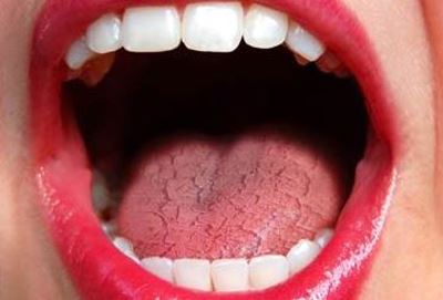 خشکی زبان و دهان چه علتی دارد+ درمان سنتی