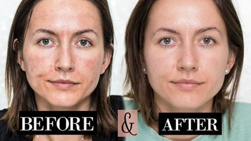 میکرونیدلینگ چیست چه فواید و مضراتی دارد؟ سن مناسب میکرو