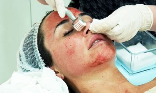 میکرونیدلینگ چیست چه فواید و مضراتی دارد؟ سن مناسب میکرو