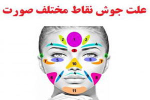 جوش روی قسمت های مختلف صورت نشانگر چه مشکلی است؟ جوش روی قسمت های مختلف صورت نشانگر چه مشکلی است؟