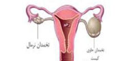 مهم ترین علت کیست تخمدان زنان+ راه درمان