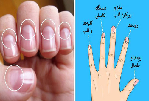 هلال سفید ناخن نشانه چیست؟ علت، علائم و راه درمان