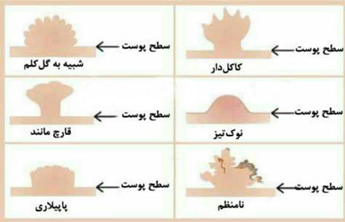 علت و علائم زیگیل تناسلی زنان و مردان چیست؟