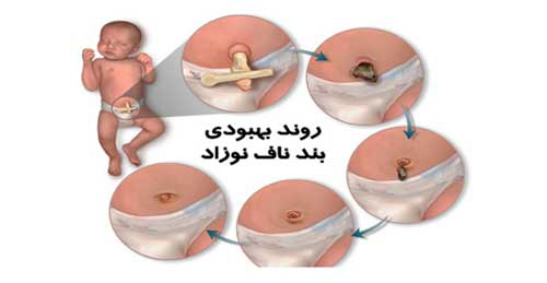 هشدار و زنگ خطرهایی که بند ناف نوزاد به شما میدهد