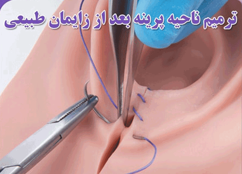 مراقبت های گام به گام واژن پس از زایمان+ انواع پارگی پرینه