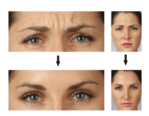 بوتاکس چیست؟ بوتاکس برای چه کسانی ممنوعه