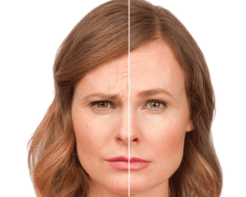 بوتاکس چیست؟ بوتاکس برای چه کسانی ممنوعه
