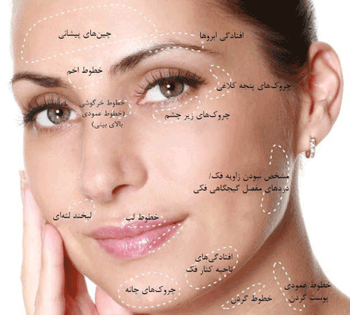 بوتاکس چیست؟ بوتاکس برای چه کسانی ممنوعه