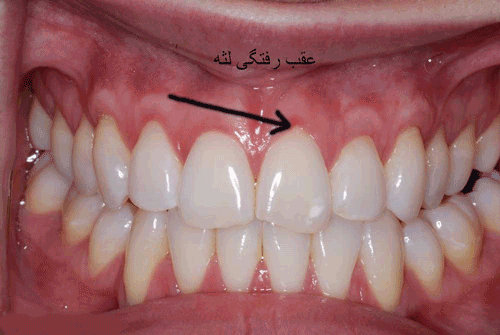 درمان خانگی و قطعی تحلیل رفتن لثه+ اسرار سفیدی دندان