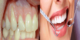 درمان خانگی و قطعی تحلیل رفتن لثه+ اسرار سفیدی دندان